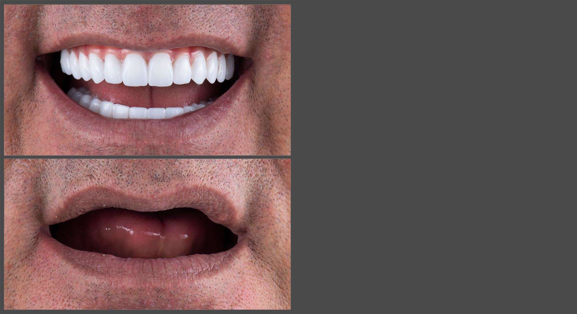 Full Mouth Dental Implant