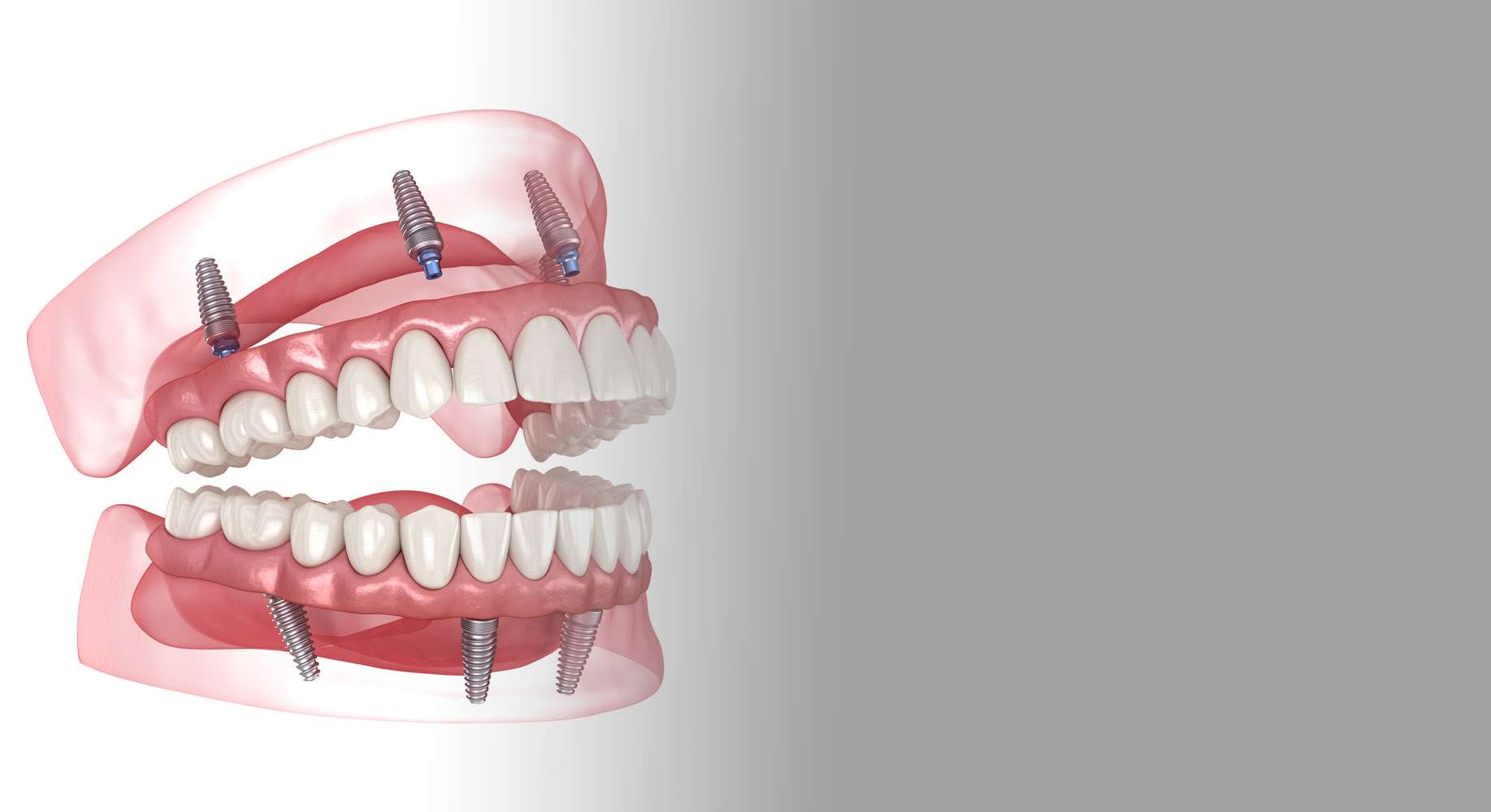 Dental Implant Center